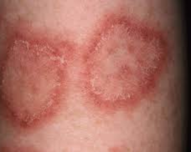 Skin Disorders Treatment