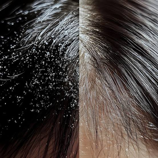 Hair & Scalp Care (केस गळणे व कोंडा उपाय) — Ayuraa Healthcare